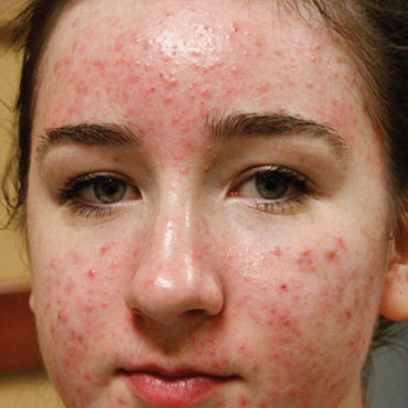 acne-treatment-before