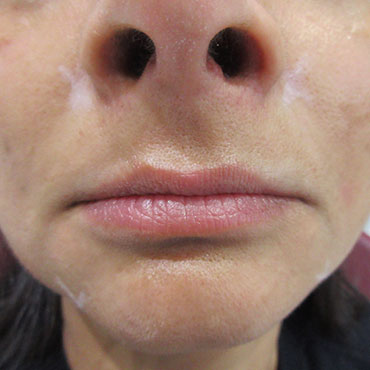 lip enhancement treatment